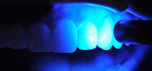 blanqueamiento dental led