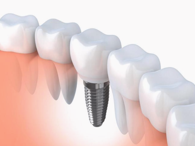 Implantes-dentales-Con-Cirugía-guiada