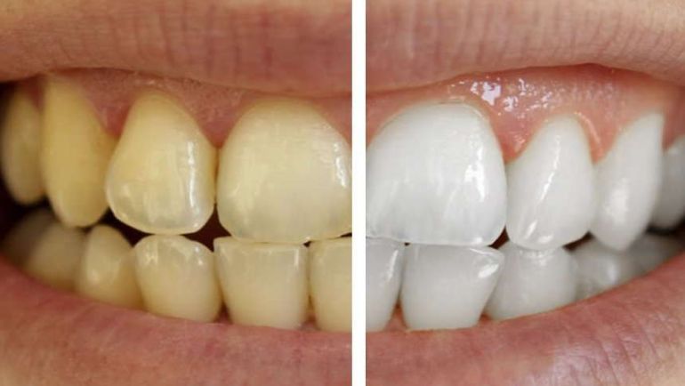 Por adelantado Reducción alojamiento Los mejores productos para blanquear los dientes | Grup Dr. Bladé