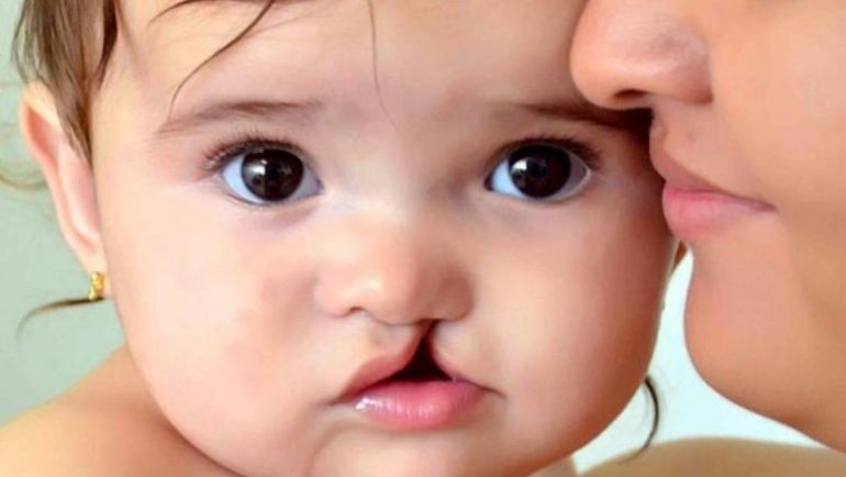 Cuidados para niños con labio leporino o paladar hendido | Grup Dr. Bladé