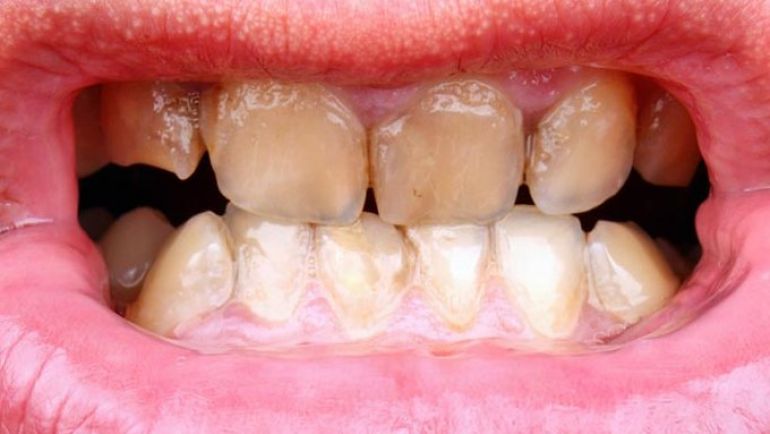 Intentar crucero alondra Cómo se quitan las manchas en los dientes? | Grup Dr. Bladé
