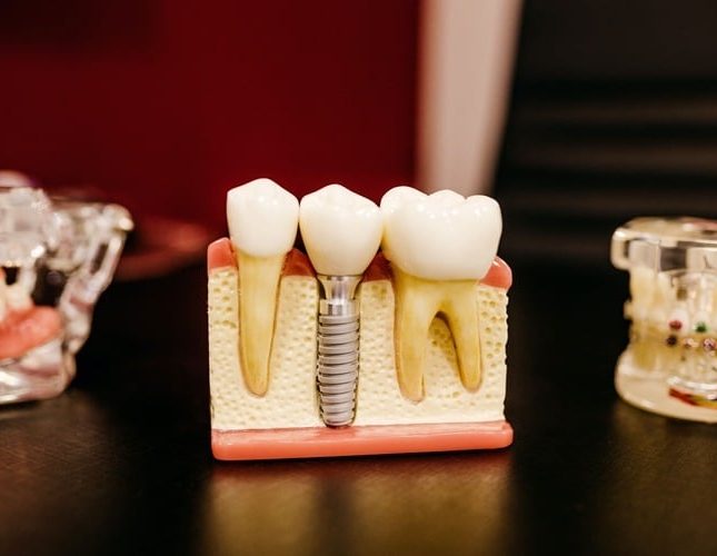 Principales problemas de los implantes dentales