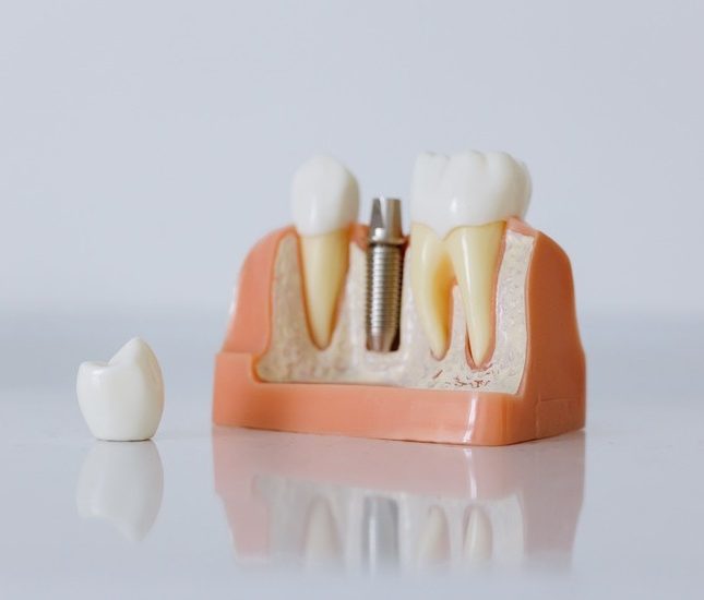 ¿Cuánto tiempo dura un implante dental?