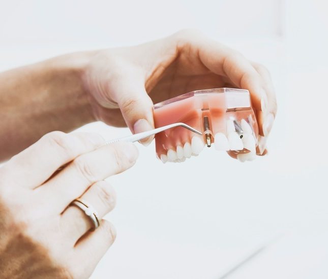 Proceso para colocar implantes dentales