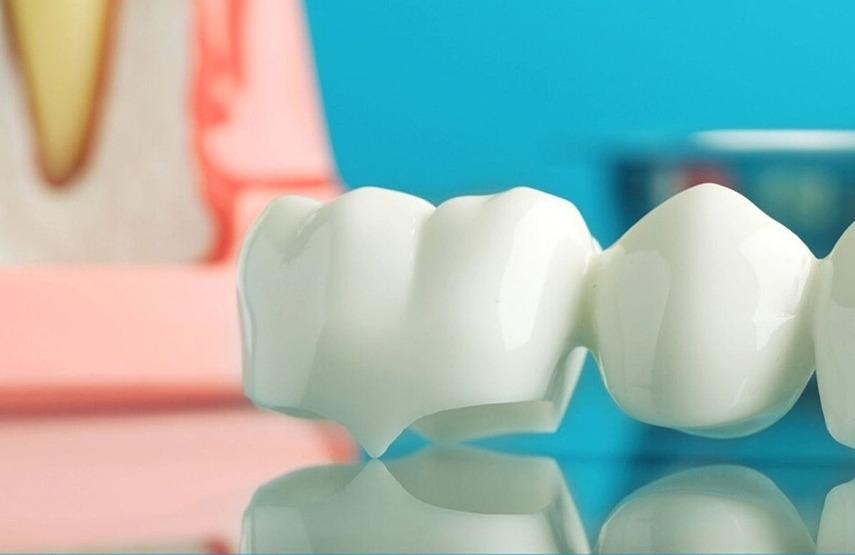 Implantes dentales sin metal
