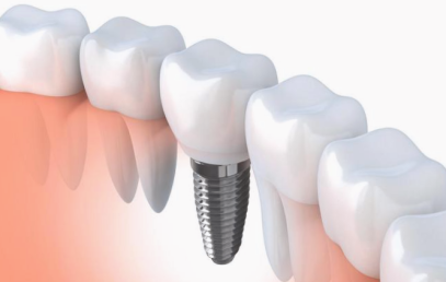 Implantes-dentales-Con-Cirugía-guiada